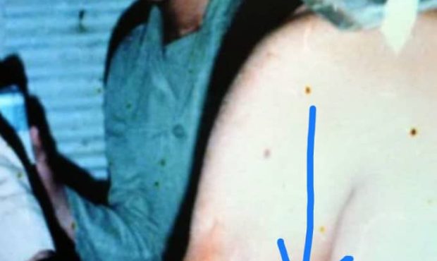 به روایت حسین کرم‌نسب: لحظات شگفت‌انگیز نجات رزمنده‌ای که گلوله خمپاره از دستش بیرون زده بود